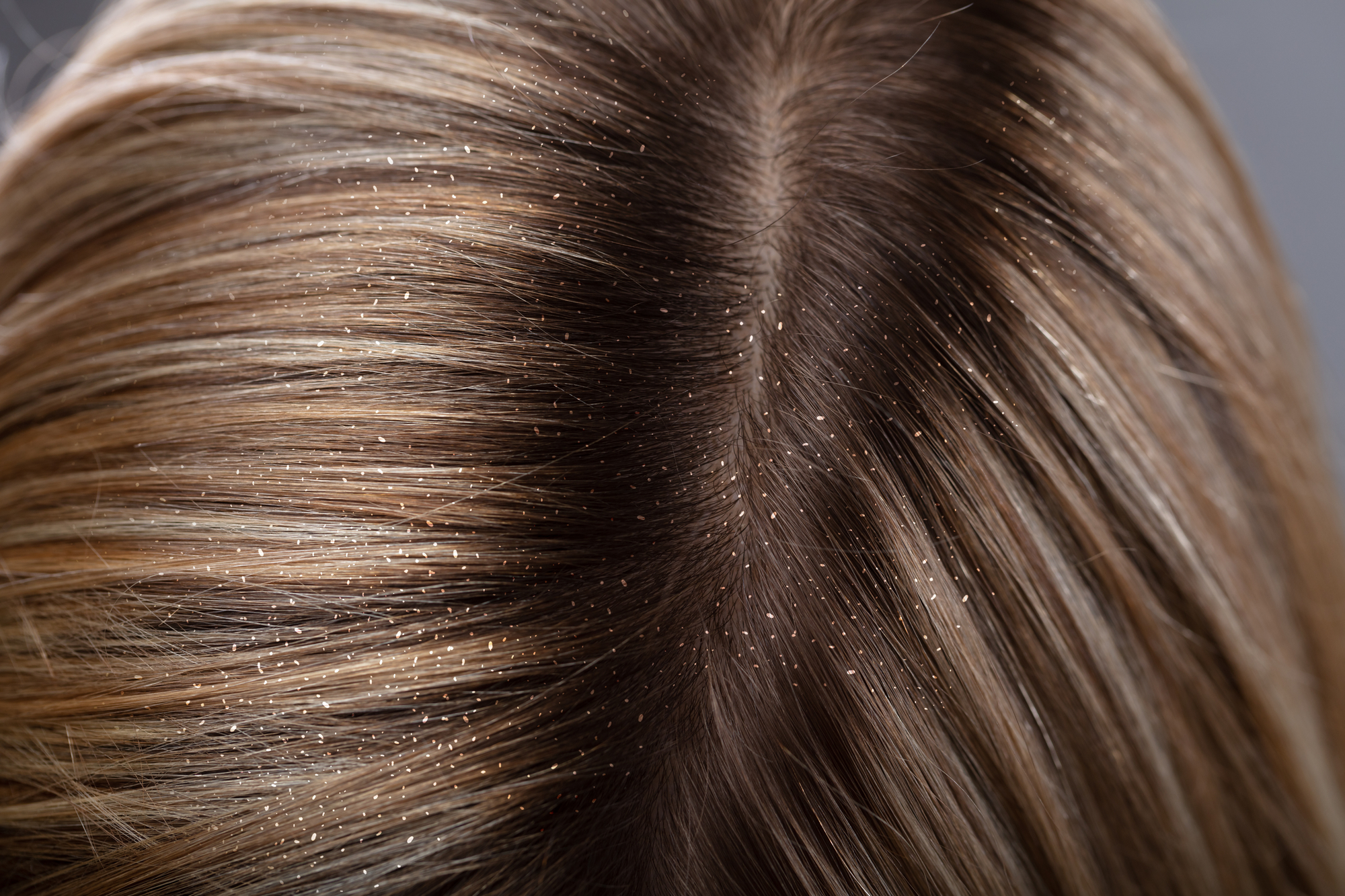 Dry, Irritated Scalp? Could Be Head Lice!
